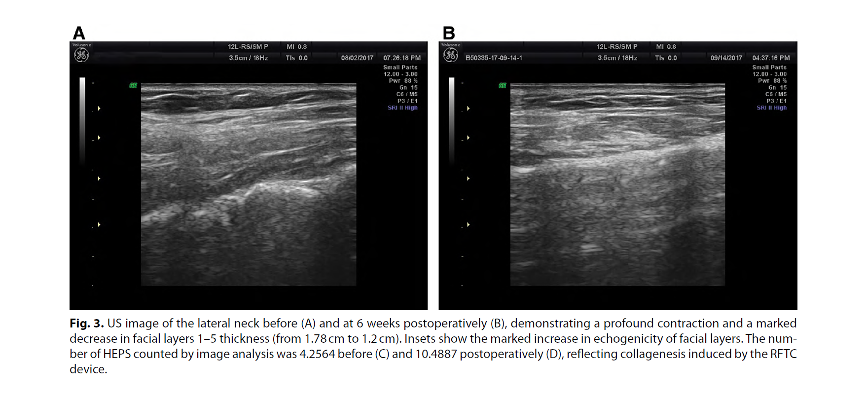 Deep Layer Radiofrequency Thermo-coagulative Technology for Cervicofacial Contouring: Sonographic and Clinical Results