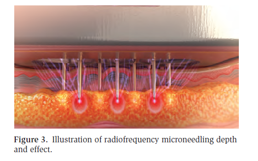 Adjustable Depth Fractional Radiofrequency Combined With Bipolar Radiofrequency: A Minimally Invasive Combination Treatment for Skin Laxity