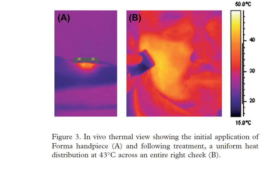 A novel non-invasive radiofrequency dermal heating device for skin tightening of the face and neck