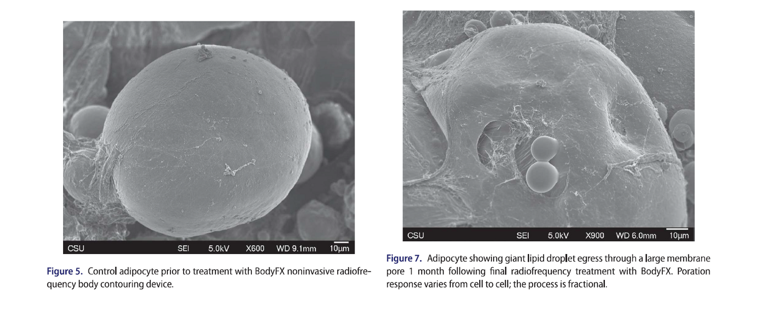 Quantification of adipose volume reduction with a prospective study analyzing the application of external radiofrequency energy and high voltage ultrashort pulse duration electrical fields