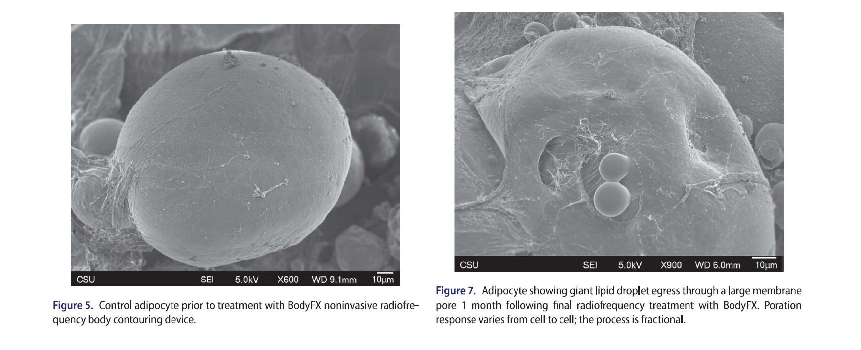 Quantification of adipose volume reduction with a prospective study analyzing the application of external radiofrequency energy and high voltage ultrashort pulse duration electrical fields
