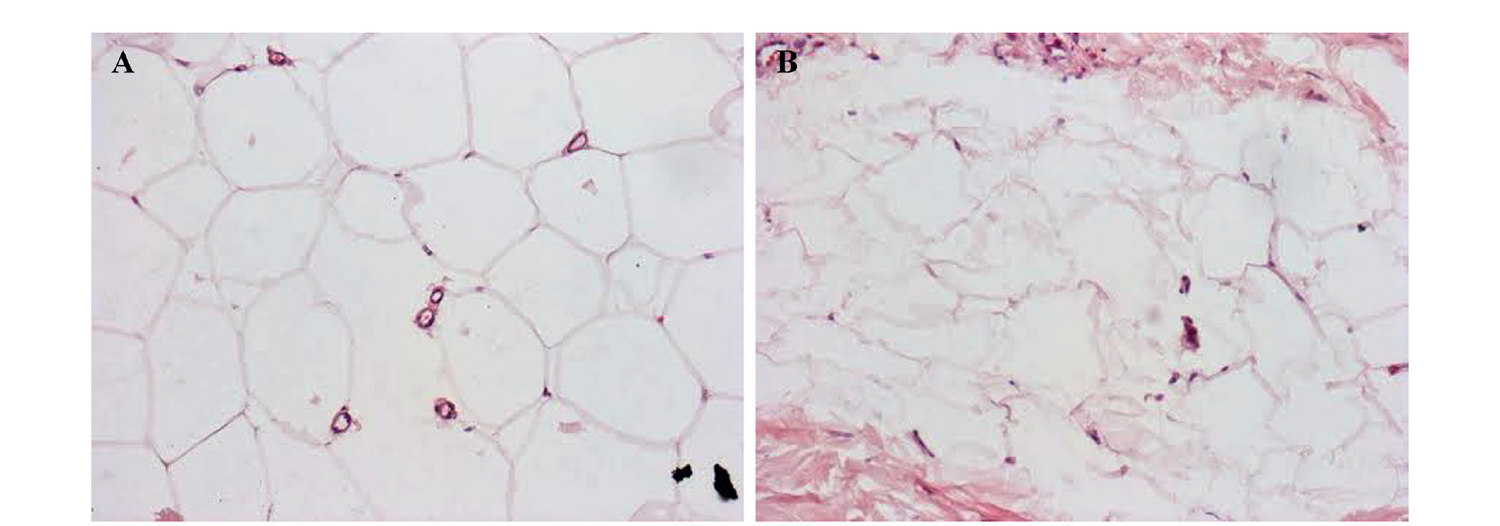 A Clinical and Biological Evaluation of a Novel, Noninvasive Radiofrequency Device for the Long-Term Reduction of Adipose Tissue