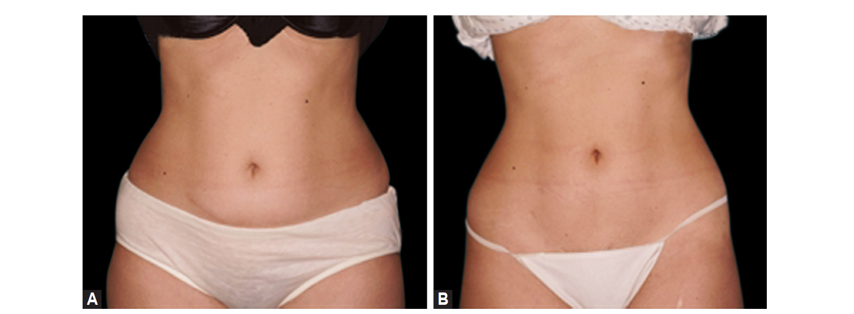Noninvasive Skin Tightening and Body Contouring