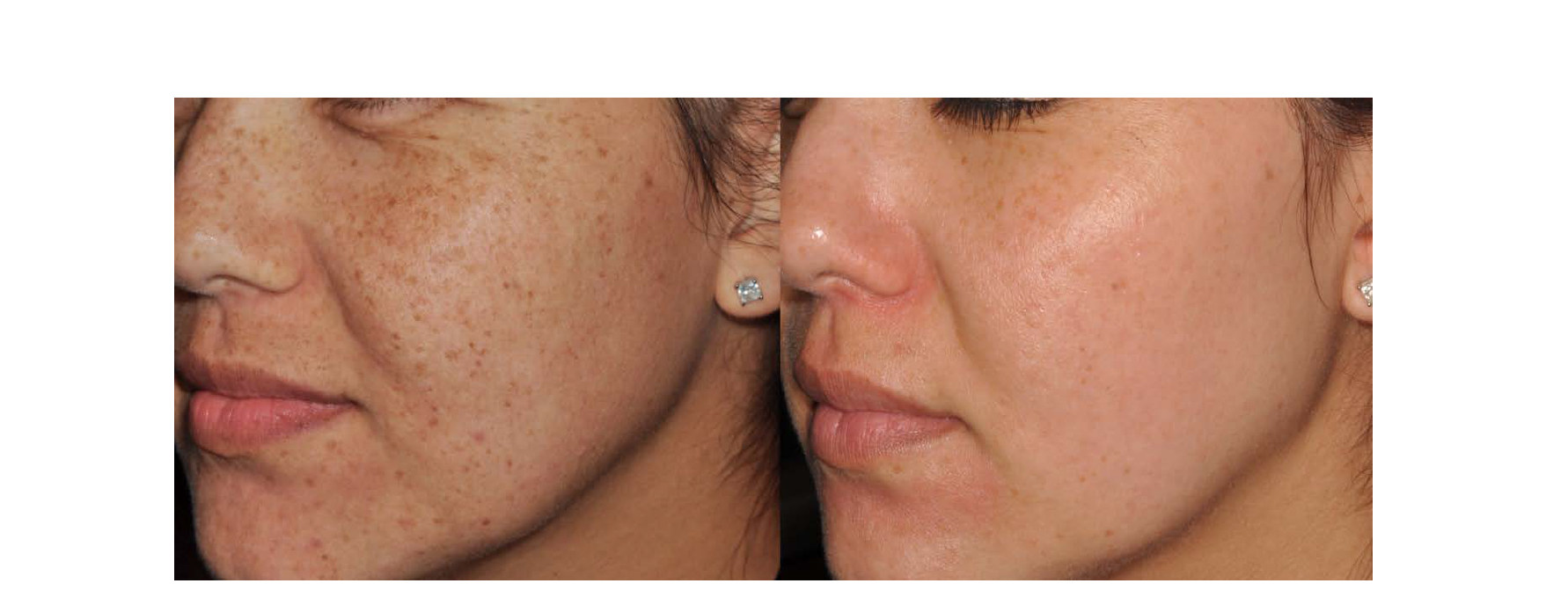 PEAK POWER EFFECT ON SKIN REJUVENATION USING IPL: LUMECCA IPL EVALUATION