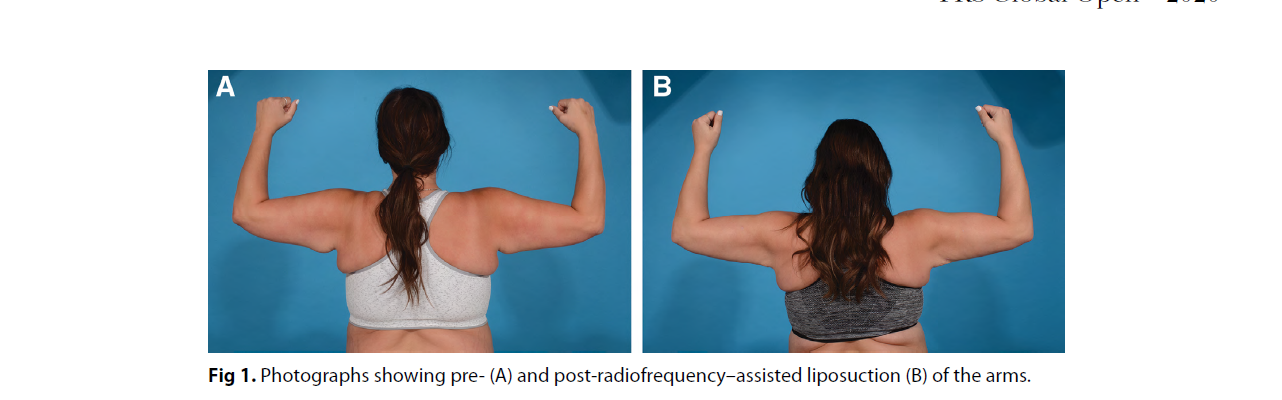 The Use of Radiofrequency in Aesthetic Surgery