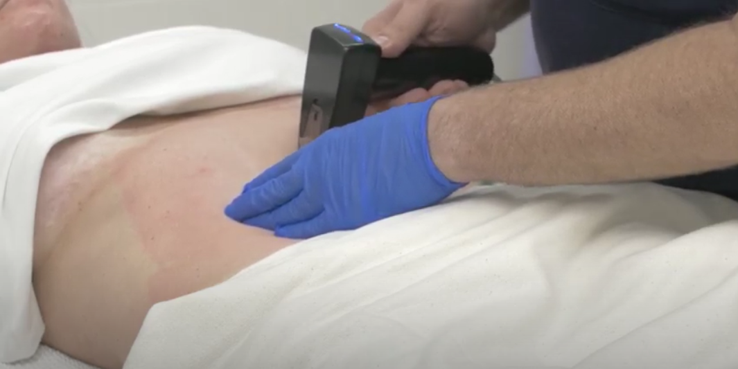 Morpheus8 Full Abdominal Treatment