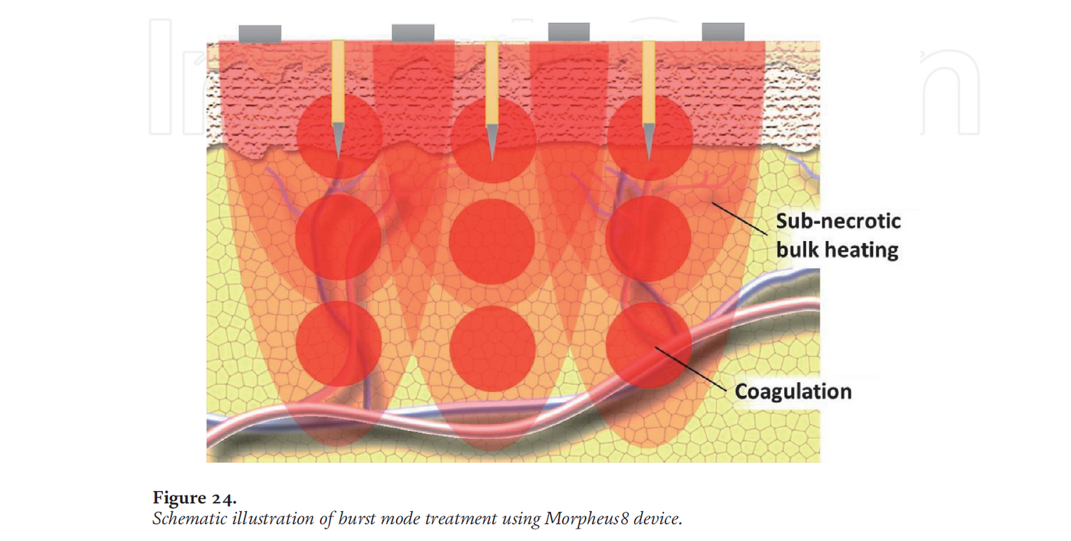 The Basic Science of Radiofrequency-Based Devices