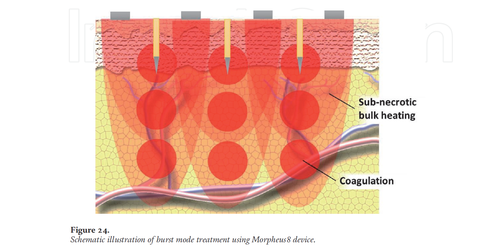 The Basic Science of Radiofrequency-Based Devices