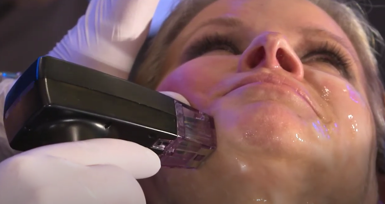 InMode University - Learn about Morpheus8 Treatment