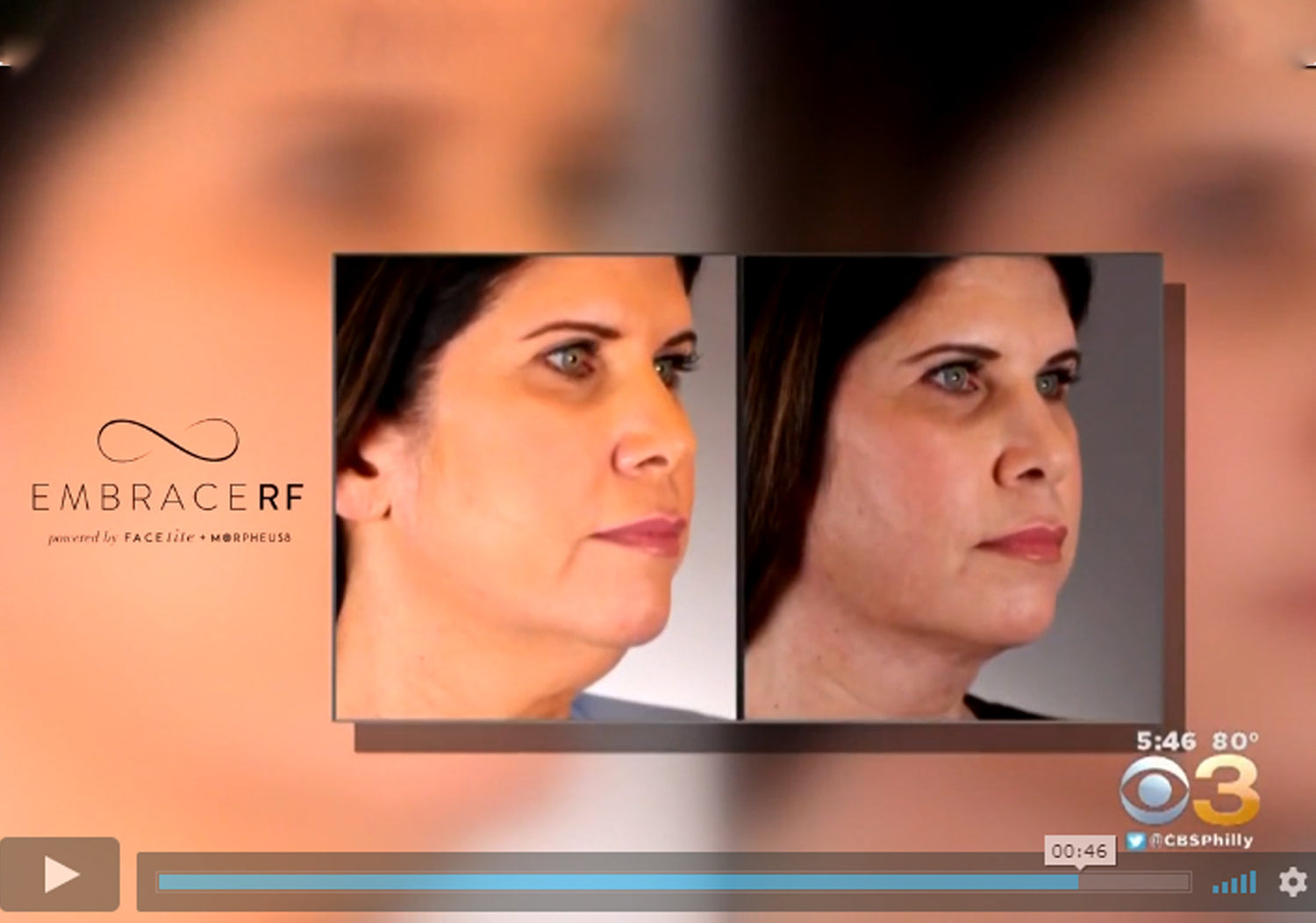 DR. SOMENEK: SHRINK WRAPS WITH EMBRACERF