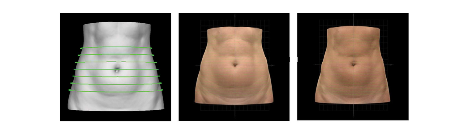 A prospective study analyzing the application of radiofrequency energy and high-voltage, ultrashort pulse duration electrical fields on the quantitative reduction of adipose tissue