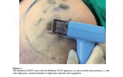 Internal and External Radiofrequency Assisted Lipo-Coagulation (RFAL) in the Control of Soft Tissue Contraction during Liposuction: Part 2 “Outside In” RFAL Thermal Tissue Tightening