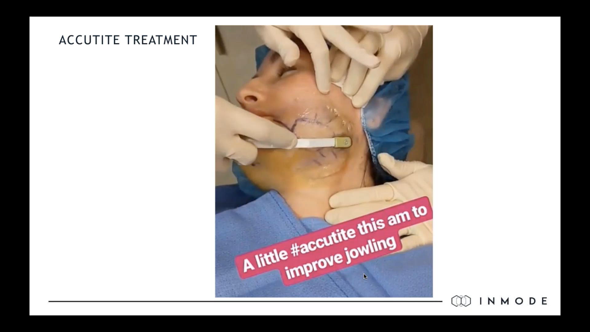 The science behind Accutite and Morpheus8 with Dr T Maningas