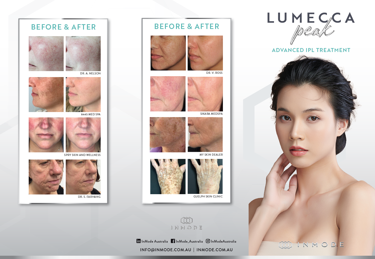 Lumecca Peak Patient Brochure x125