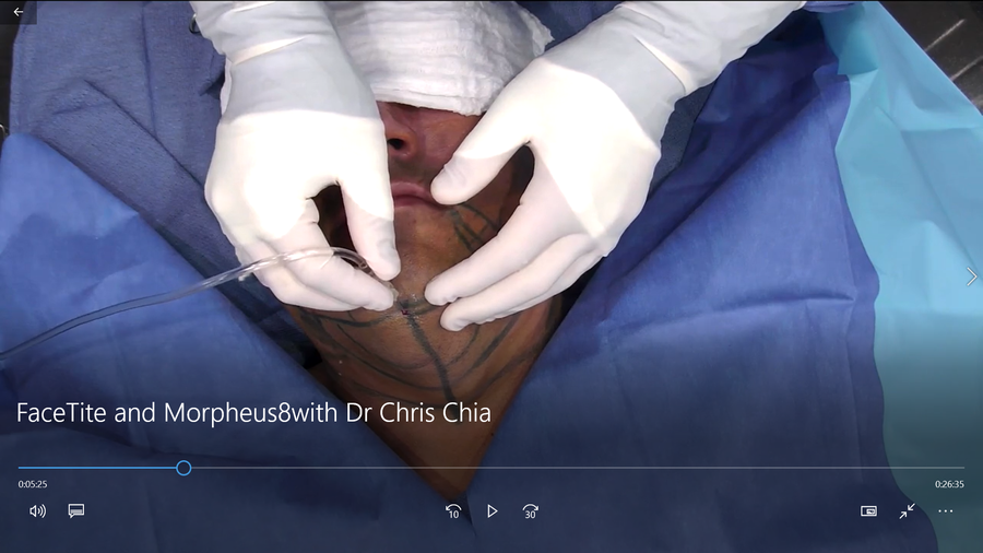 Testing FaceTite and Morpheus8 with Dr Chris Chia