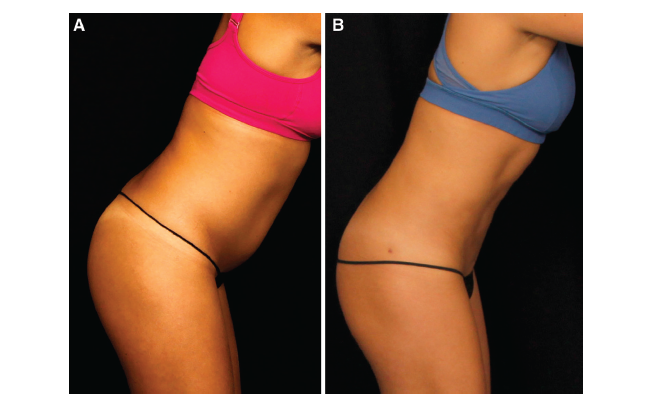 Second Generation Radiofrequency Body Contouring Device: Safety and Efficacy in 300 Local Anesthesia Liposuction Cases