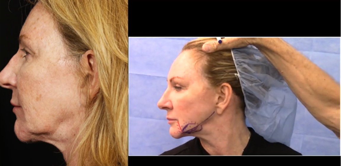 Live Demo: Jowl and Jawline Contouring with FaceTite RF – Dr. Sherrell Aston