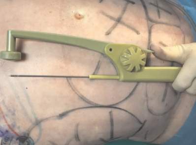 BodyTite®: The Science and Art of Radiofrequency Assisted Lipocoagulation (RFAL) in Body Contouring Surgery