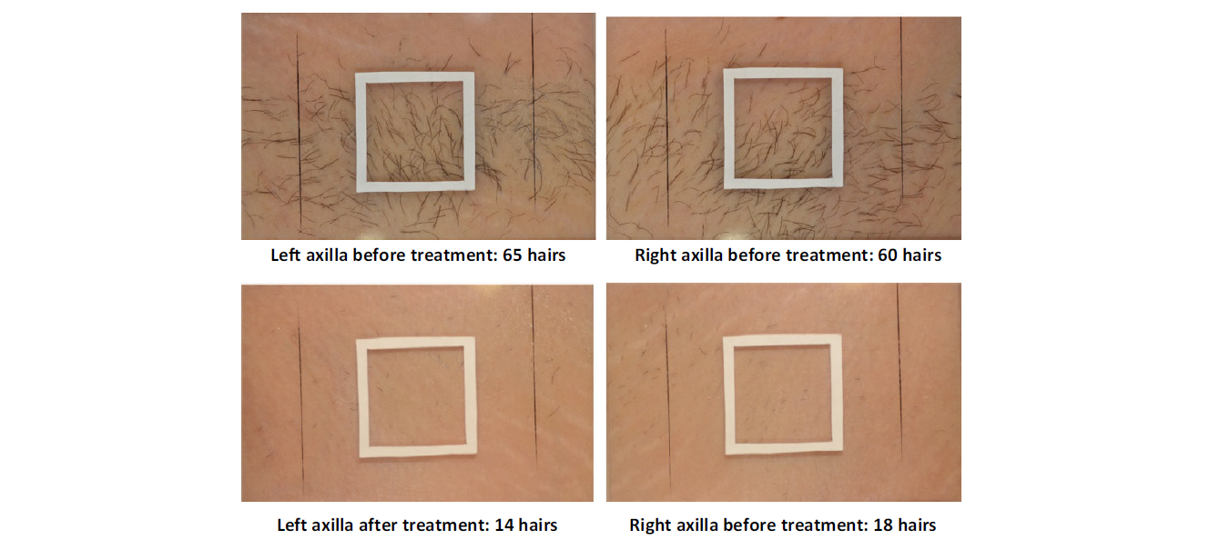 One‐year follow‐up results of hair removal using an 810 nm diode laser