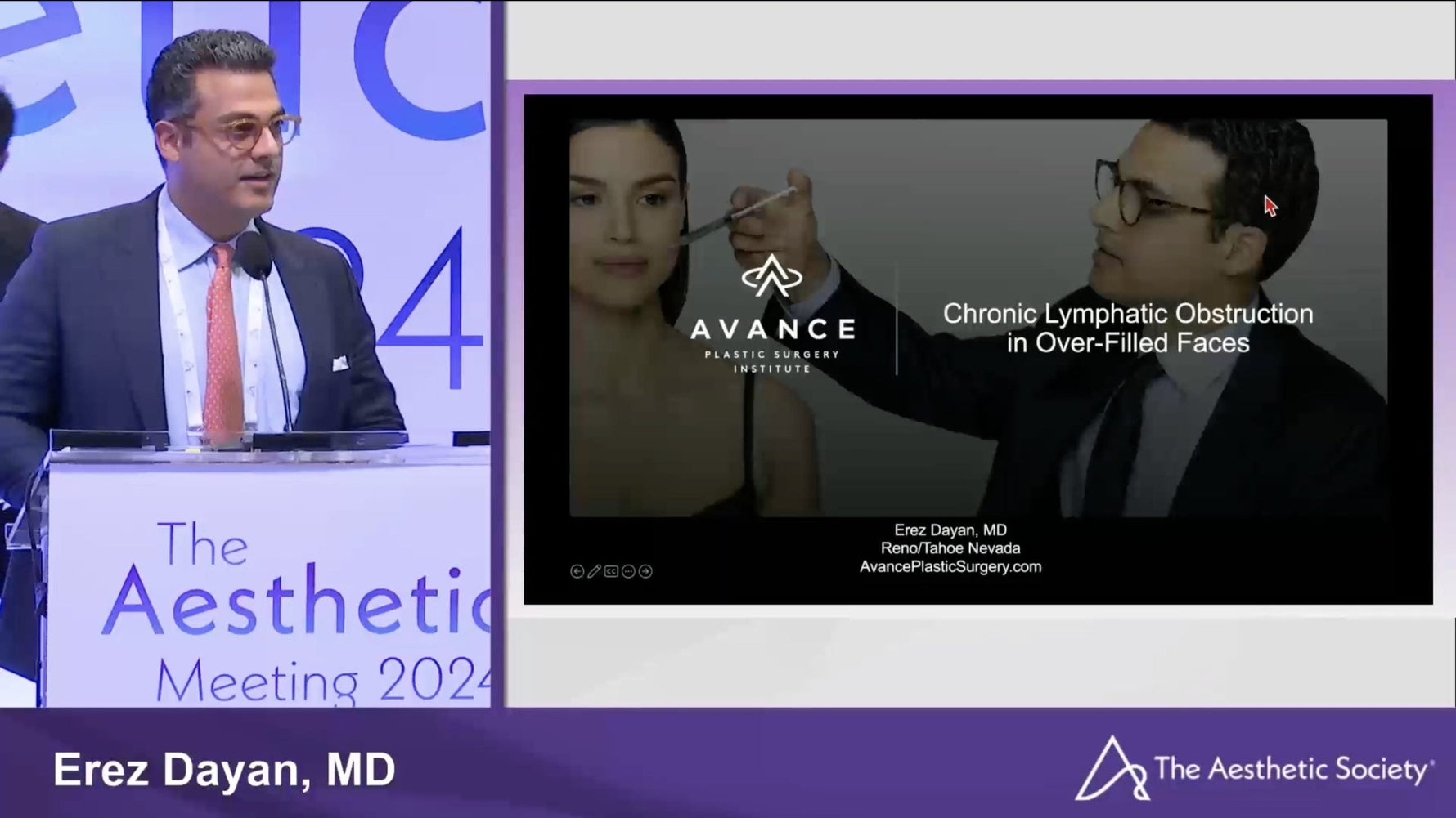 Webinar: Treating PHAREE Filler Complications with Morpheus8 – Dr. Erez Dayan