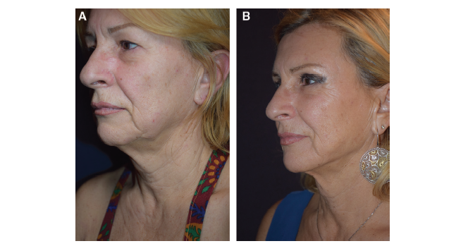 Multimodal Radiofrequency Application for Lower Face and Neck Laxity