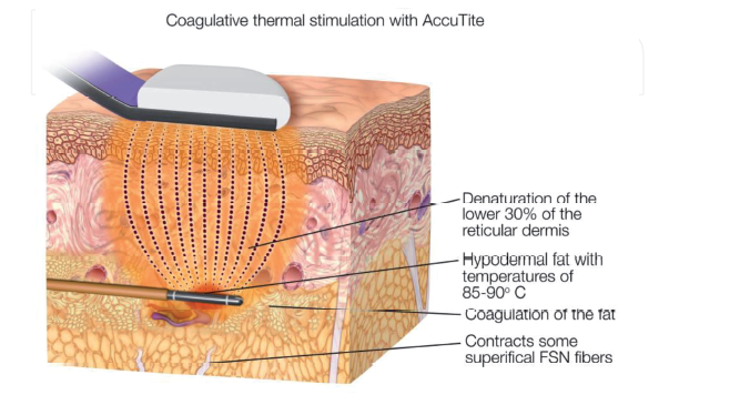 Internal and External Radiofrequency Assisted Lipo-Coagulation (RFAL) in the Control of Soft Tissue Contraction during Liposuction: Part 1 “Inside Out” Thermal Tissue Tightening