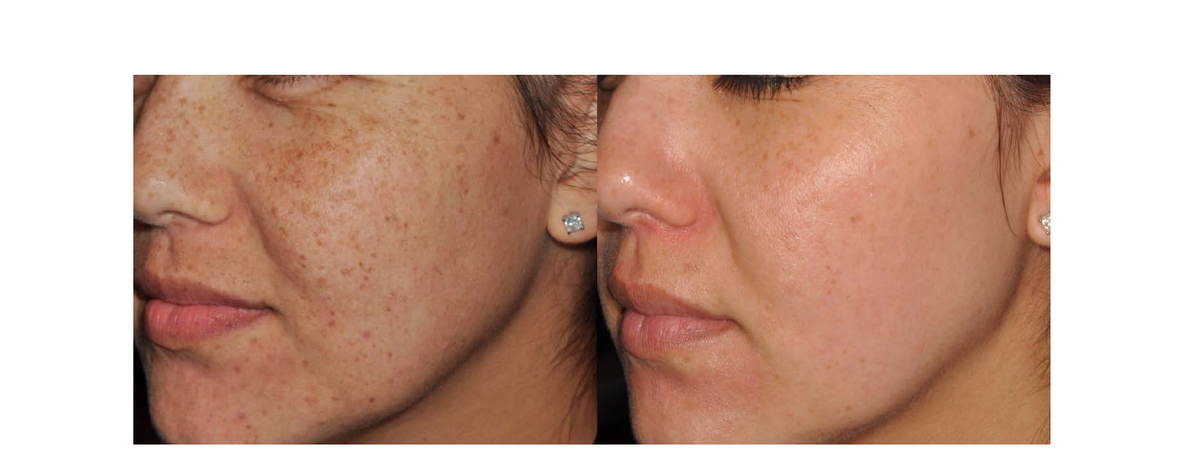 PEAK POWER EFFECT ON SKIN REJUVENATION USING IPL: LUMECCA IPL EVALUATI ...