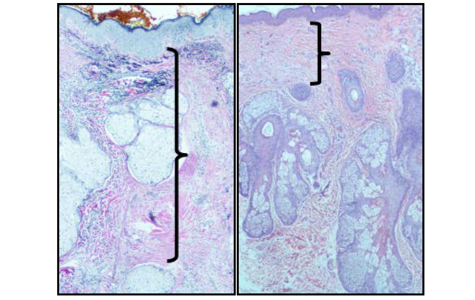 Novel Histological Evidence of Collagen and Elastin Regeneration in Fractional RF-Treated Acne Scars