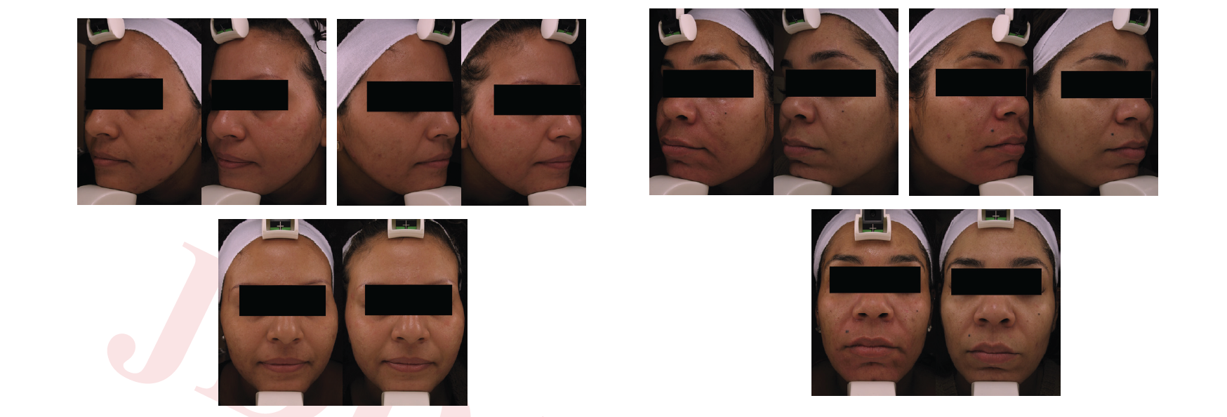The Fate of Active Acne and Acne Scars Following Treatment With Fractional Radiofrequency