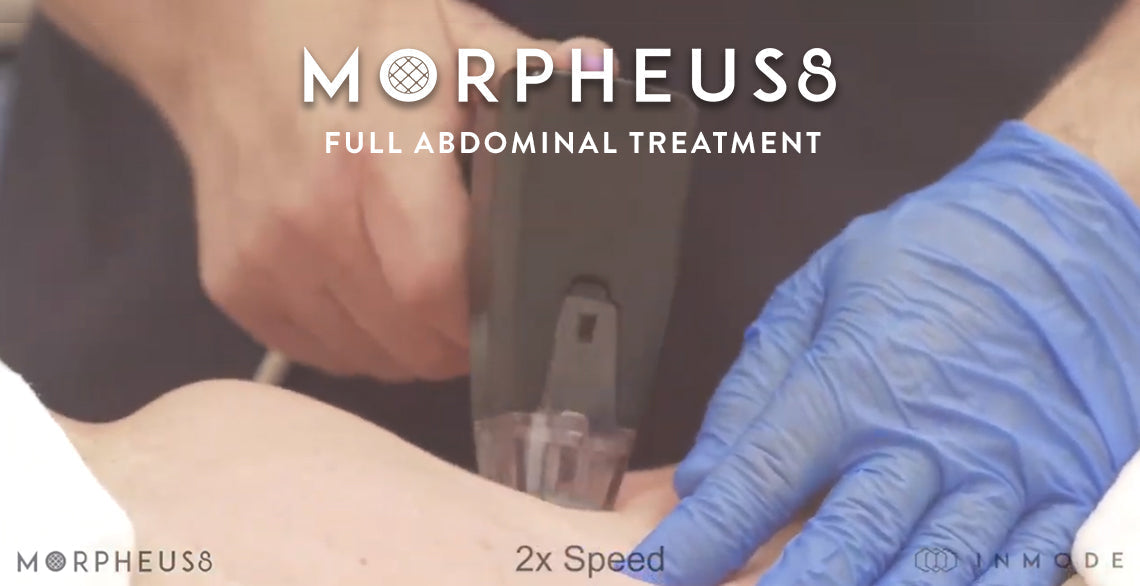 Live Demo: Abdominal Skin Tightening with Morpheus8 RF – Dr. Nicholas Nikolov