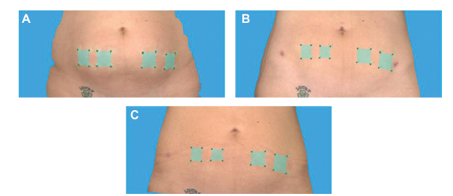 Nonexcisional Tissue Tightening: Creating Skin Surface Area Reduction During Abdominal Liposuction by Adding Radiofrequency Heating