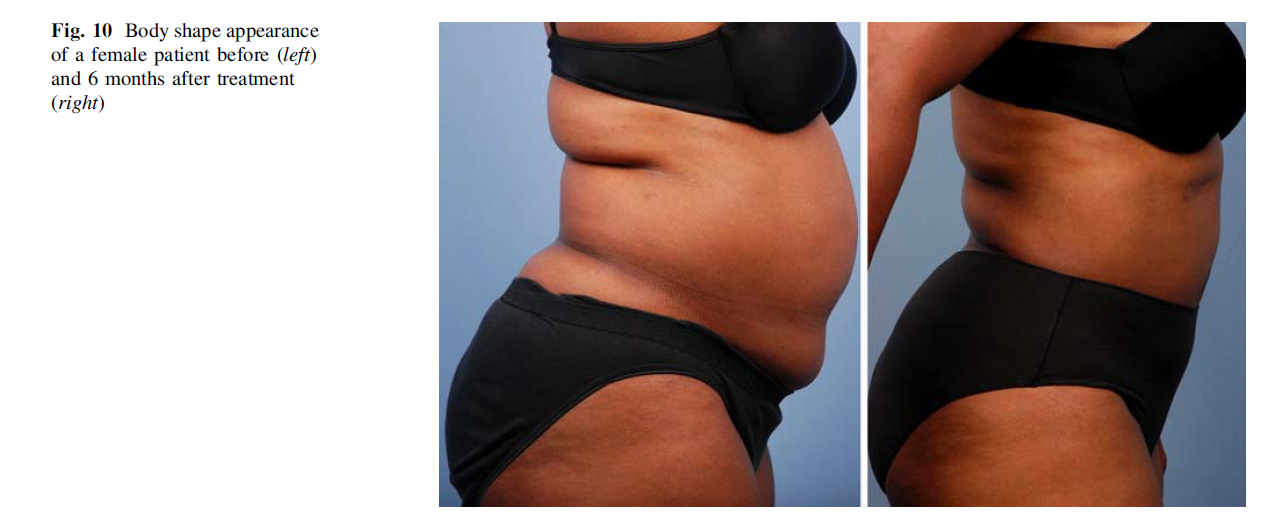 A New Approach for Adipose Tissue Treatment and Body Contouring Using Radiofrequency-Assisted Liposuction