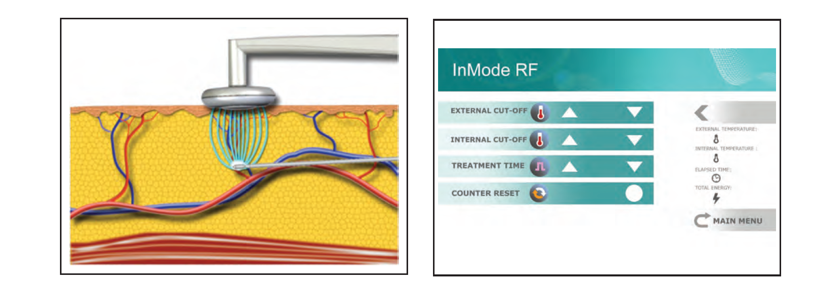 Soft Tissue Contraction in Body Contouring With Radiofrequency-Assisted Liposuction: A Treatment Gap Solution