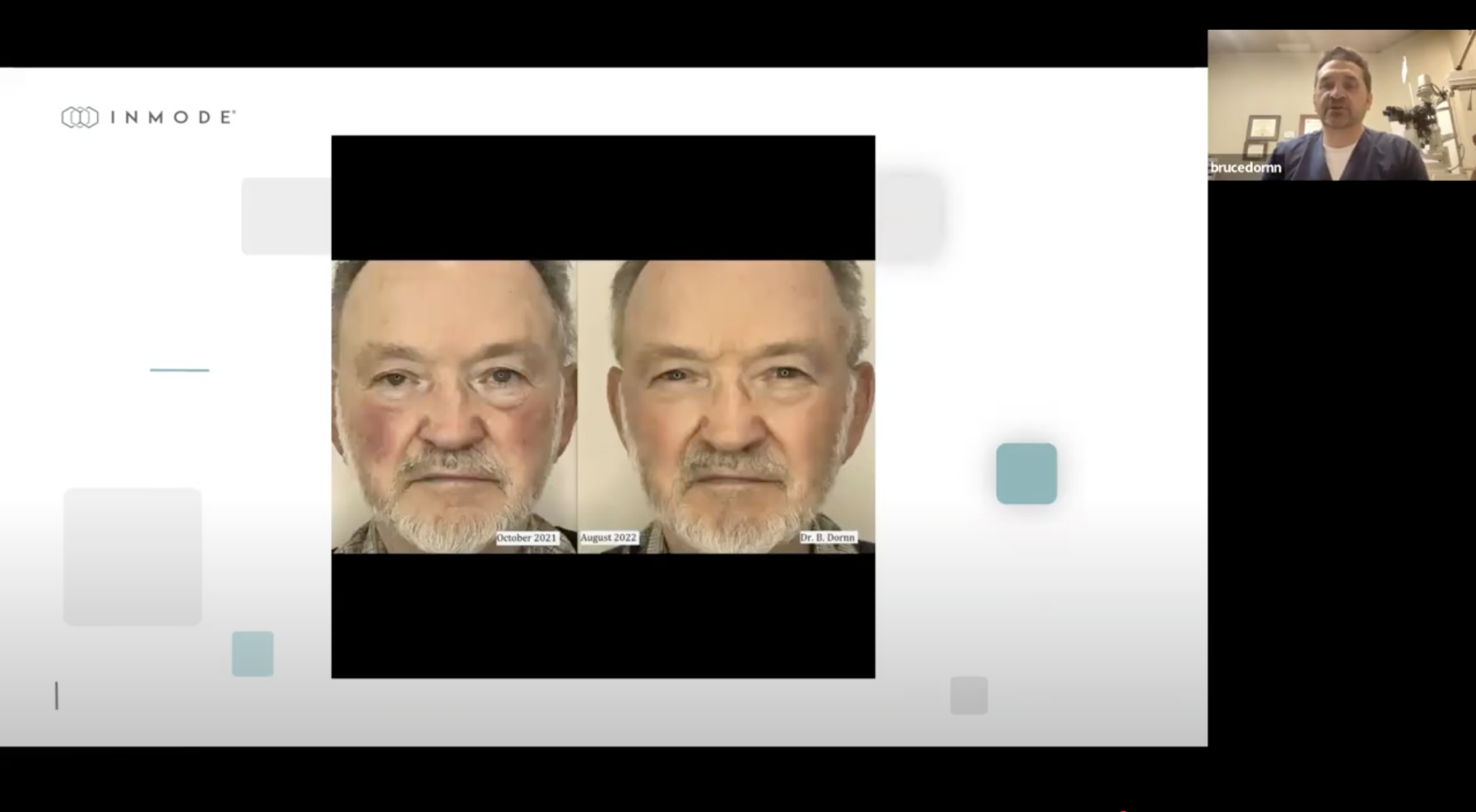 Webinar: Advanced Treatment of Dry Eye with Envision – Dr. Bruce Dornn