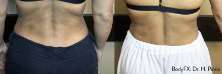 Retrospective Analysis of Treatment Results by Non-Invasive Radiofrequency (RF) Device with Standard and High Voltage RF Electrical Pulses Coupled with Suction for Fat Reduction and Cellulite Improvement