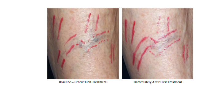 Evaluation of a new diode laser for the treatment of lower extremity leg veins
