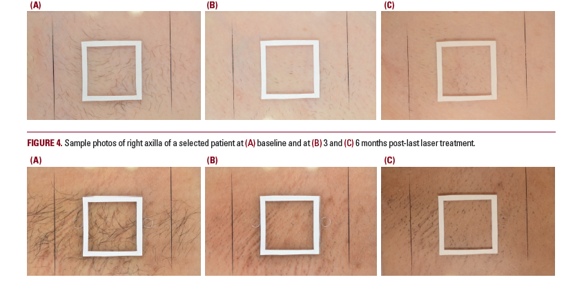 Clinical Evaluation of Hair Removal Using an 810 nm Diode Laser With a Novel Scanning Device