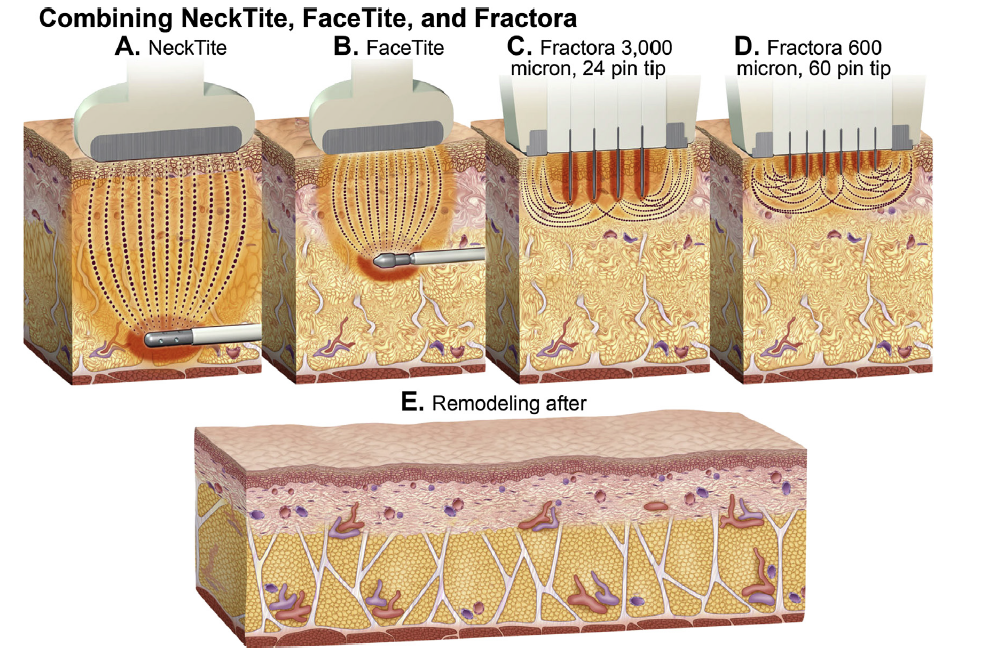 Nonexcisional, Minimally Invasive Rejuvenation of the Neck
