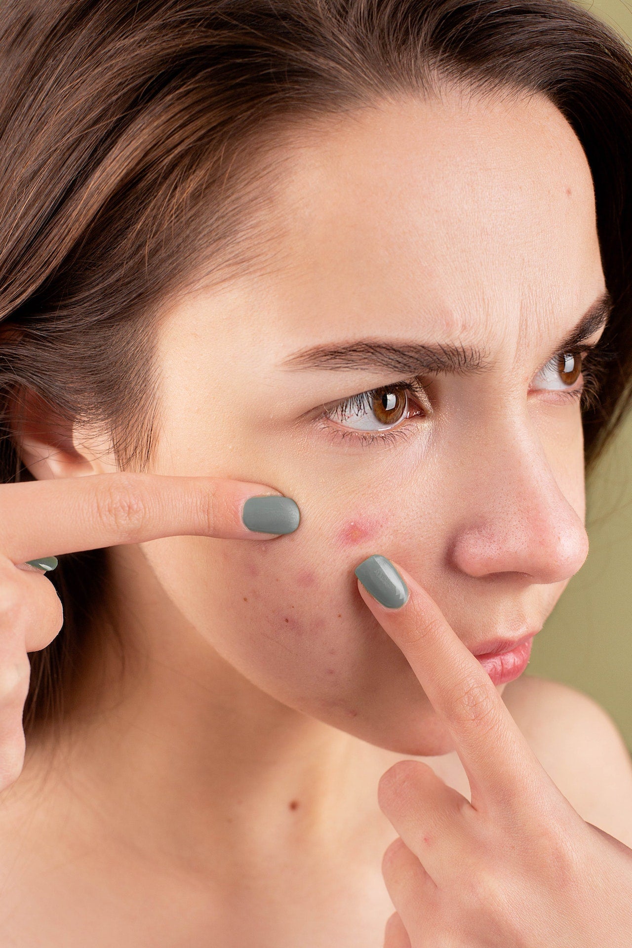 What is acne and how to treat acne scarring?