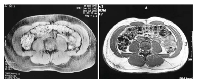 A Safety and Feasibility Study of a Novel Radiofrequency-Assisted Liposuction Technique