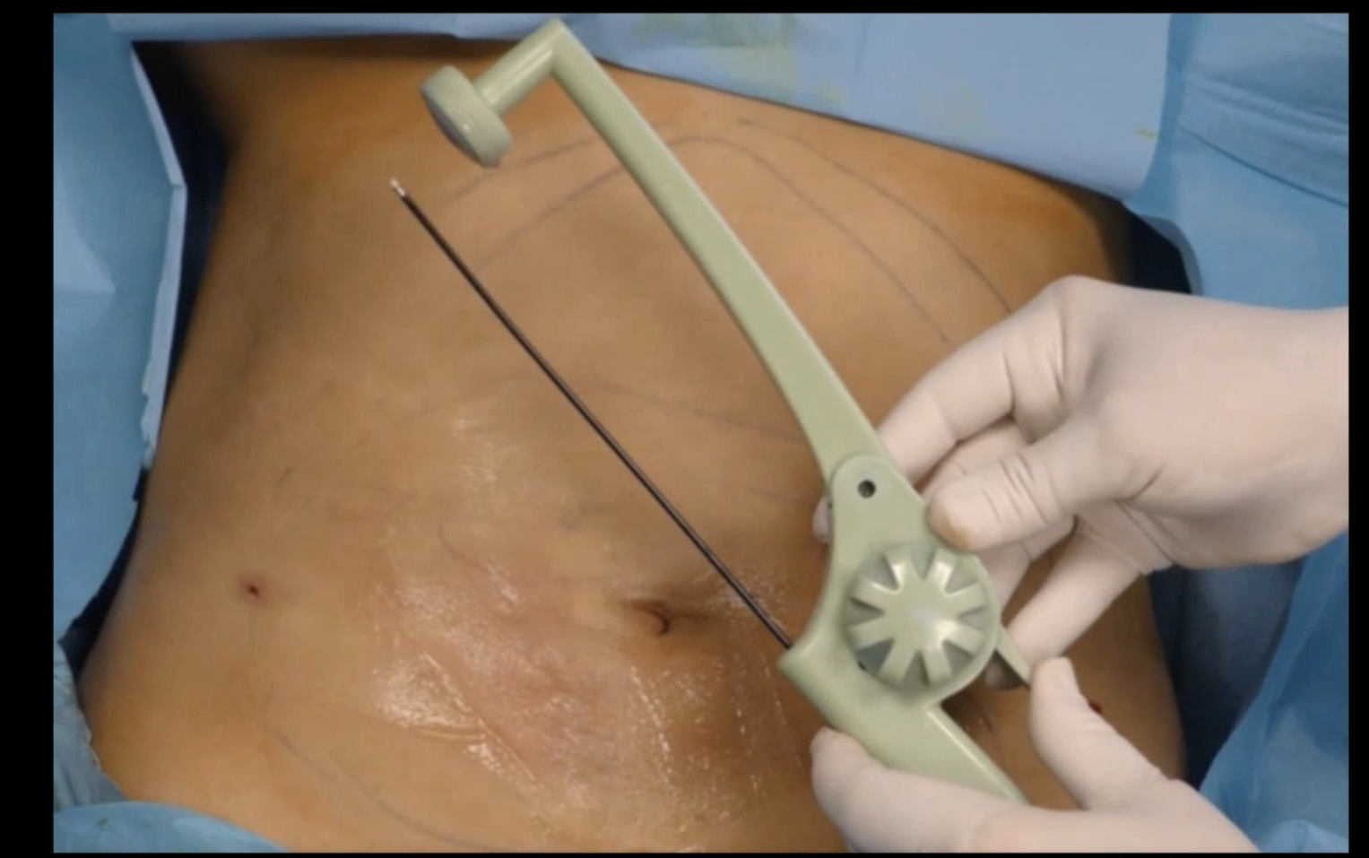 Liposculpture with InMode RFAL by Dr Rovatti