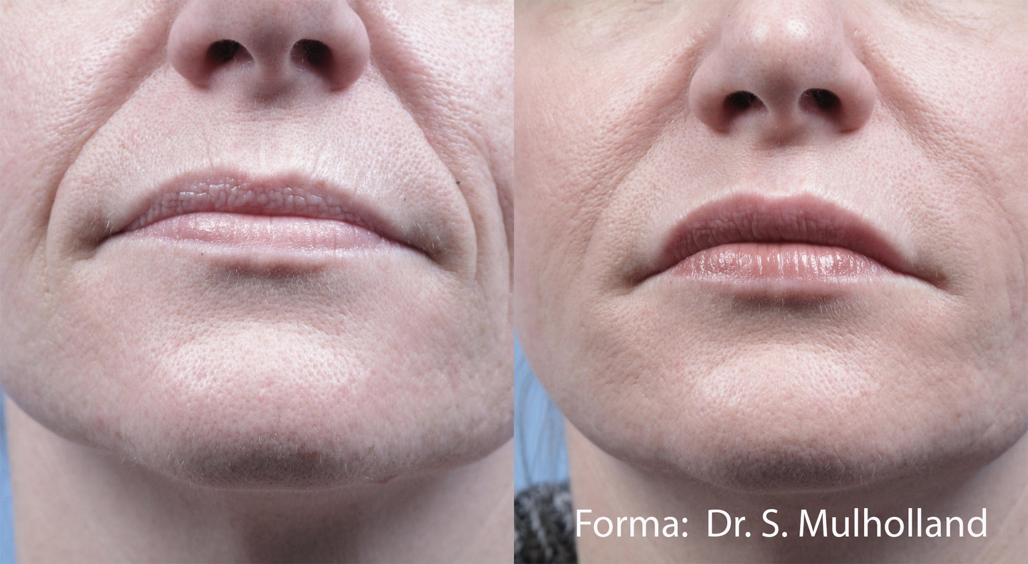 Forma I Non Invasive Skin Tightening Machine I InMode