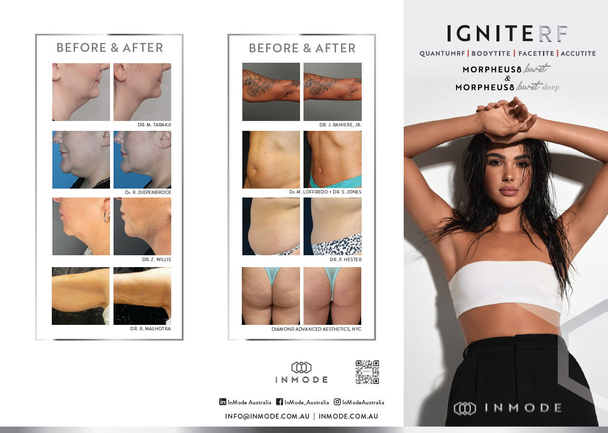 IgniteRF Patient Brochure x125