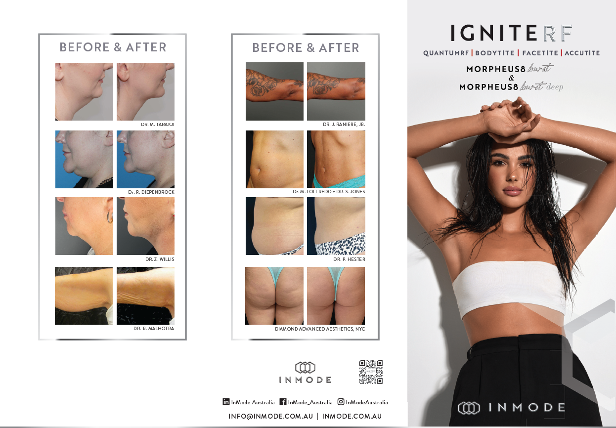 IgniteRF Patient Brochure (Chinese) x125